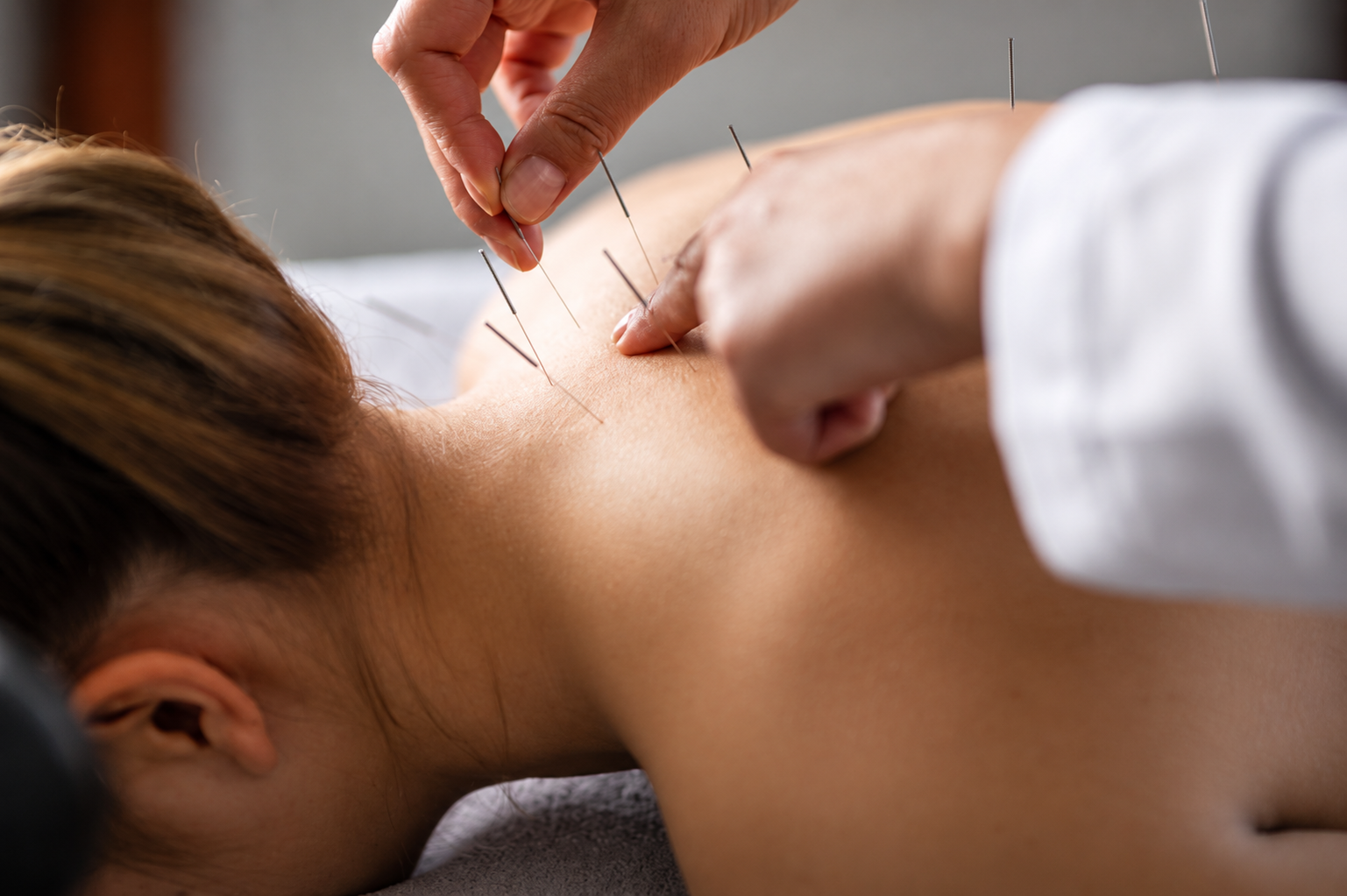 Acupuncture